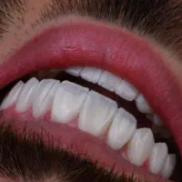 کامپوزیت دندان