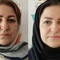 کرم بوتاکس/بیوممتیک جایگزین فیلرو بوتاکس