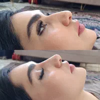 آفر ویژه ژل و بوتاکس