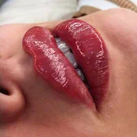 کلینیک تزریق ژل بوتاکس390 توسط پزشک لیزرشاتی هایفو