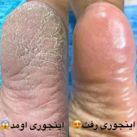 پدیکور درمانی خشک و خیس حتی عزیزانی که پسوریازیس|خدمات آرایشگری و زیبایی|ری, شهرری|دیوار