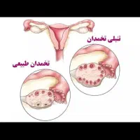 تنبلی تخمدان و مشکلات هورمونی