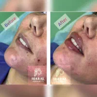 تخفیفات ویژه لیزر فیلر بوتاکس خالبرداری فیشال|خدمات آرایشگری و زیبایی|تهران, یافت آباد شمالی|دیوار