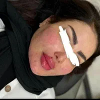 تزریقات ژل بوتاکس..  کاشت ابرو .ومو|خدمات آرایشگری و زیبایی|اسلام‌شهر, باغ فیض|دیوار