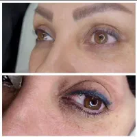 جشنواره ریمووتکجلسه بدون دردتضمینی باتخفیف۱میلیونی|خدمات زیبایی و سلامت|قم, عمار یاسر|دیوار