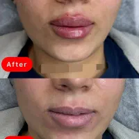تزریق فیلر و بوتاکس