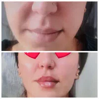 بوتاکس مصپورت فقط ۵۵۰وفیلر ۶۹۰ پی ارپی ۸۵۰|خدمات آرایشگری و زیبایی|اصفهان, رزمندگان|دیوار