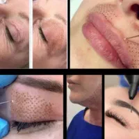 پلکسر بینی   وغبقب