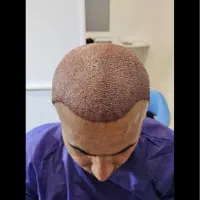 جشنواره نوروزی کاشت تخصصی مو با ضمانت فقط۹میلیون