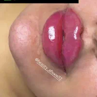 تخفیف استثنایی خدمات ژل فیلر بوتاکس|خدمات آرایشگری و زیبایی|کرج, گلشهر|دیوار