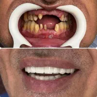 ایمپلنت دندان باقیمتی مناسب و کیفیتی بالا