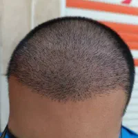 کاشت مو و ریش آقایان بدون جراحی و خونریزی