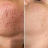 رفع تیرگی صورت وبدن فیشال تخصصی