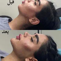 جشنواره  تزریق چربی لیزر لاغری ژل بوتاکس|خدمات آرایشگری و زیبایی|تهران, هفت حوض|دیوار