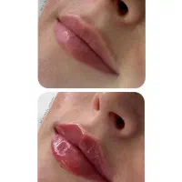 مدل جهت فیلر (صورت و بدن) و بوتاکس