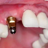 خدمات تخصصی ایمپلنت نقدواقساط۱۸ماه