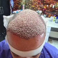 کاشت مو ابرو ریش مزوتراپی و پی آرپی جشنواره پاییزه|خدمات آرایشگری و زیبایی|اردبیل, |دیوار