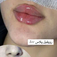 آف یلدایی تزریق ژل و بوتاکس|خدمات آرایشگری و زیبایی|ملایر, |دیوار