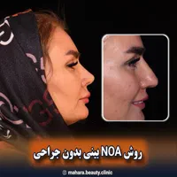 فرم دهی بینی بدون جراحی و بیهوشی رینوپلاستی NOA|خدمات آرایشگری و زیبایی|مشهد, هفت تیر (حافظ)|دیوار