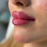 فیلر بوتاکس ژل مزو اقساط با ۵۰ % تخفیف توسط دکتر