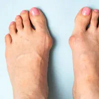 کلینیک تخصصی درمان هالوکس والگوس (شصت پای کج)