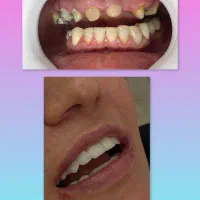 دندانپزشکی/لمینیت /کامپوزیت/روکش/اقساطی