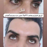 50٪تخفیف خدمات فیلر بوتاکس مزوتراپی پرسینگ چال لپ|خدمات آرایشگری و زیبایی|اصفهان, مولوی|دیوار