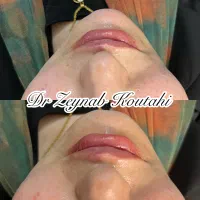 تزریقات ژل و بوتاکس