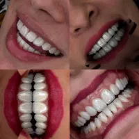 دندانپزشکی دنو اقساطی با چک یا سفته|خدمات زیبایی و سلامت|تهران, شهران شمالی|دیوار