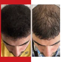 نجات موهای ضعیف و کم پشت