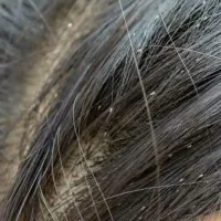 رشک وشپش