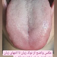 تشخیص بیماری ها فقط از روی عکس زبان بصورت ناشتا