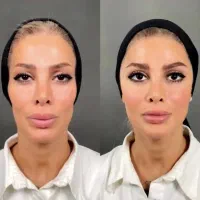 تخفیف خدمات  مدلینگ فیلر بوتاکس مزوژل خانم و آقا