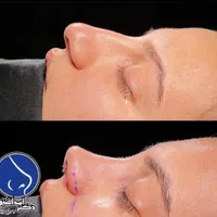 جراحی زیبایی بینی فقط با 22 ملیون