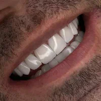 دندانپزشکی.کامپوزیت.لمینت|خدمات آرایشگری و زیبایی|تهران, علم و صنعت|دیوار