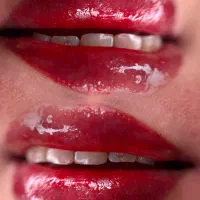 میکروبلیدینگ وفیبروز