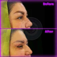 جشنواره ویژه بلفاروپلاستی(جراحی زیبایی پلک)|خدمات آرایشگری و زیبایی|دیلم, |دیوار