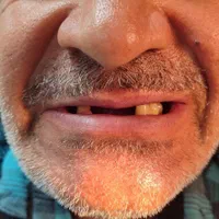 اولین و تنها مرکز دندانسازی بدون لقی در لردگان|خدمات آرایشگری و زیبایی|لردگان, |دیوار