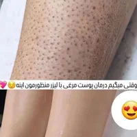 لیزر موهای زائد با سری شخصی تضمینی وکیل آباد|خدمات آرایشگری و زیبایی|مشهد, هفت تیر (حافظ)|دیوار