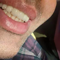 روکش های دندانی(پروتز های دندانی)|خدمات آرایشگری و زیبایی|ارومیه, |دیوار