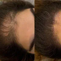 میکرواسکالپ تخصصی با جدیدترین متدvip