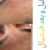 تخفیفات ویژه خدمات آموزش فشیال اکستنشن هیدن لیفت|خدمات آرایشگری و زیبایی|قرچک, میرزائی شمالی|دیوار