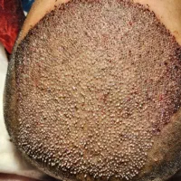 کاشت مو طبیعی ۱۷ میلیون دو روزه