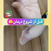 بهبود زگیل/تبخال/hpv/hsv|آرایشی، بهداشتی، درمانی|قم, یخچال قاضی|دیوار