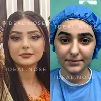 جشنواره عمل زیبایی بینی با تخفیف ویژه|خدمات آرایشگری و زیبایی|سقز, |دیوار