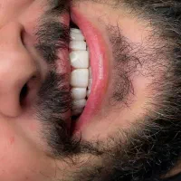 کامپوزیت دندان اقساط ۴ ماهه بدون پیش پرداخت|خدمات آرایشگری و زیبایی|کرج, گلشهر|دیوار