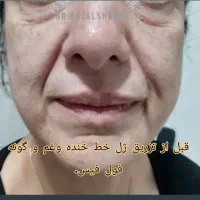 مطب زیبایی دکتر کژال شاه ویسی تزریق ژل بوتاکس..|خدمات آرایشگری و زیبایی|سنندج, |دیوار