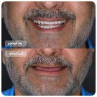 ایمپلنت اقساطی//جشنواره ایمپلنت سوئیسی و کره ای