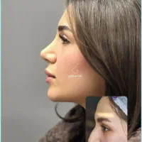 مشاوره تخصصی و رایگان عمل بینی