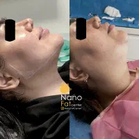 لیپوفیس سوپرکانتور ساکشن غبغب لیپوغبغب کلینیک لارا|خدمات آرایشگری و زیبایی|تهران, صادقیه|دیوار